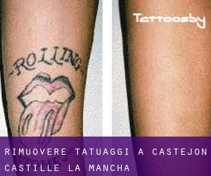 Rimuovere Tatuaggi a Castejón (Castille-La Mancha)