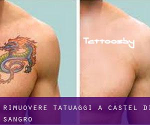 Rimuovere Tatuaggi a Castel di Sangro