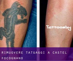 Rimuovere Tatuaggi a Castel Focognano