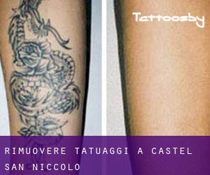 Rimuovere Tatuaggi a Castel San Niccolò