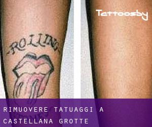 Rimuovere Tatuaggi a Castellana Grotte