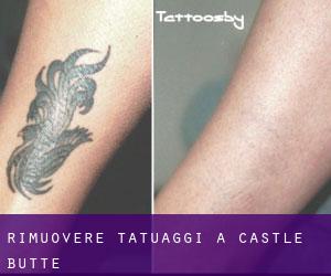 Rimuovere Tatuaggi a Castle Butte