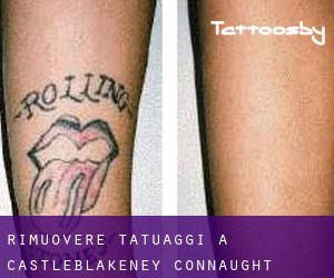 Rimuovere Tatuaggi a Castleblakeney (Connaught)