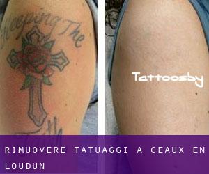 Rimuovere Tatuaggi a Ceaux-en-Loudun