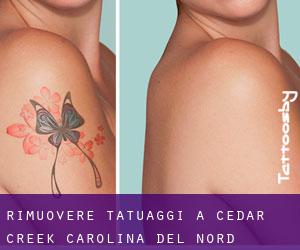 Rimuovere Tatuaggi a Cedar Creek (Carolina del Nord)