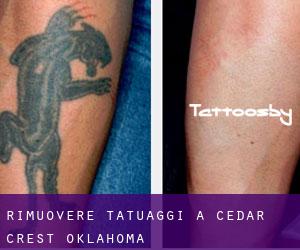 Rimuovere Tatuaggi a Cedar Crest (Oklahoma)