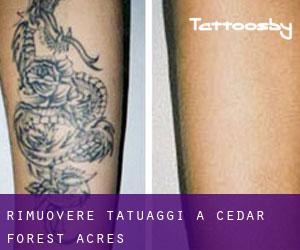 Rimuovere Tatuaggi a Cedar Forest Acres