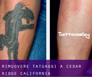 Rimuovere Tatuaggi a Cedar Ridge (California)