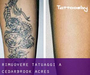 Rimuovere Tatuaggi a Cedarbrook Acres