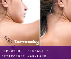 Rimuovere Tatuaggi a Cedarcroft (Maryland)