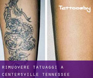 Rimuovere Tatuaggi a Centersville (Tennessee)