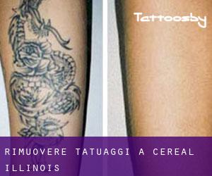 Rimuovere Tatuaggi a Cereal (Illinois)