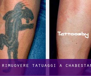 Rimuovere Tatuaggi a Chabestan