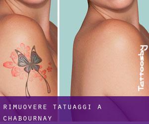 Rimuovere Tatuaggi a Chabournay