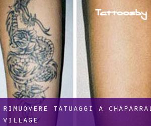 Rimuovere Tatuaggi a Chaparral Village