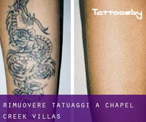 Rimuovere Tatuaggi a Chapel Creek Villas