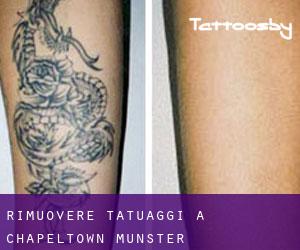 Rimuovere Tatuaggi a Chapeltown (Munster)