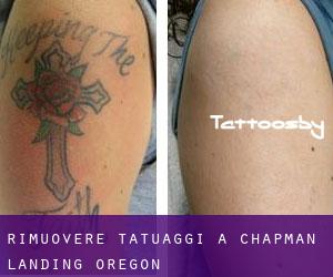 Rimuovere Tatuaggi a Chapman Landing (Oregon)