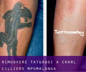 Rimuovere Tatuaggi a Charl Cilliers (Mpumalanga)