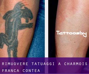 Rimuovere Tatuaggi a Charmois (Franca Contea)