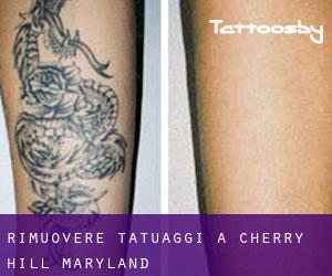 Rimuovere Tatuaggi a Cherry Hill (Maryland)