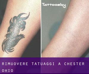 Rimuovere Tatuaggi a Chester (Ohio)