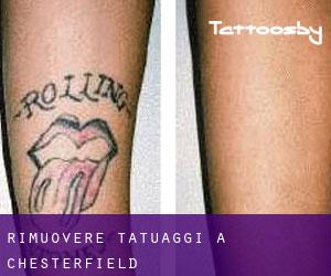 Rimuovere Tatuaggi a Chesterfield