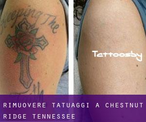 Rimuovere Tatuaggi a Chestnut Ridge (Tennessee)