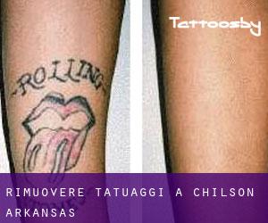 Rimuovere Tatuaggi a Chilson (Arkansas)