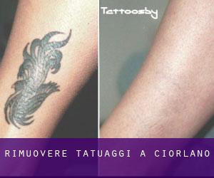 Rimuovere Tatuaggi a Ciorlano