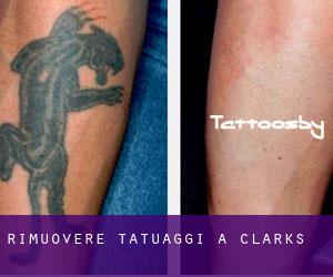 Rimuovere Tatuaggi a Clarks