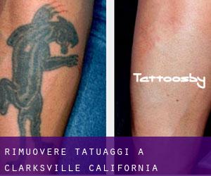 Rimuovere Tatuaggi a Clarksville (California)