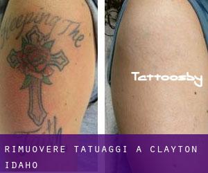 Rimuovere Tatuaggi a Clayton (Idaho)
