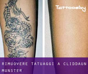 Rimuovere Tatuaggi a Cliddaun (Munster)