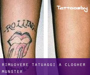 Rimuovere Tatuaggi a Clogher (Munster)