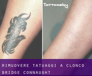 Rimuovere Tatuaggi a Clonco Bridge (Connaught)