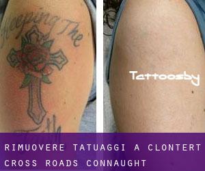 Rimuovere Tatuaggi a Clontert Cross Roads (Connaught)