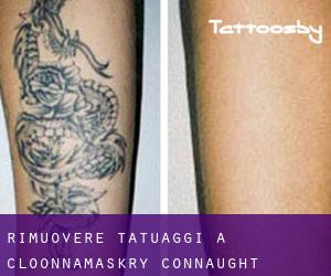 Rimuovere Tatuaggi a Cloonnamaskry (Connaught)