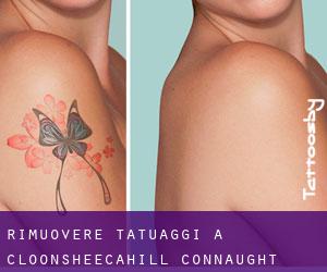 Rimuovere Tatuaggi a Cloonsheecahill (Connaught)