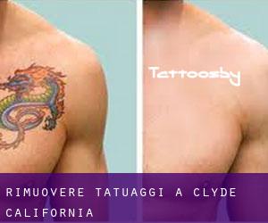 Rimuovere Tatuaggi a Clyde (California)