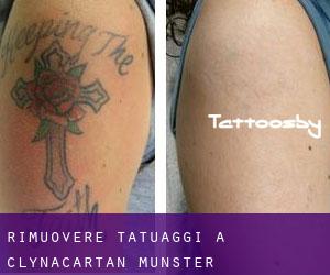 Rimuovere Tatuaggi a Clynacartan (Munster)