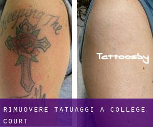 Rimuovere Tatuaggi a College Court