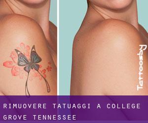 Rimuovere Tatuaggi a College Grove (Tennessee)