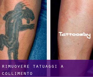 Rimuovere Tatuaggi a Collimento