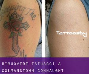 Rimuovere Tatuaggi a Colmanstown (Connaught)