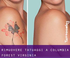 Rimuovere Tatuaggi a Columbia Forest (Virginia)