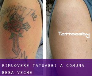 Rimuovere Tatuaggi a Comuna Beba Veche