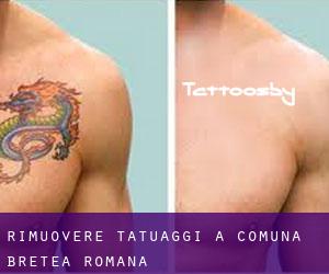 Rimuovere Tatuaggi a Comuna Bretea Română