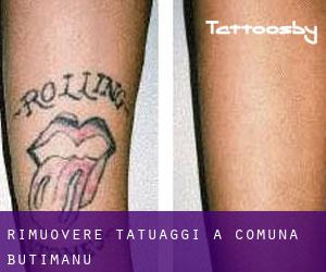 Rimuovere Tatuaggi a Comuna Butimanu