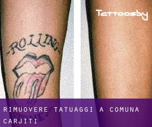 Rimuovere Tatuaggi a Comuna Cârjiţi